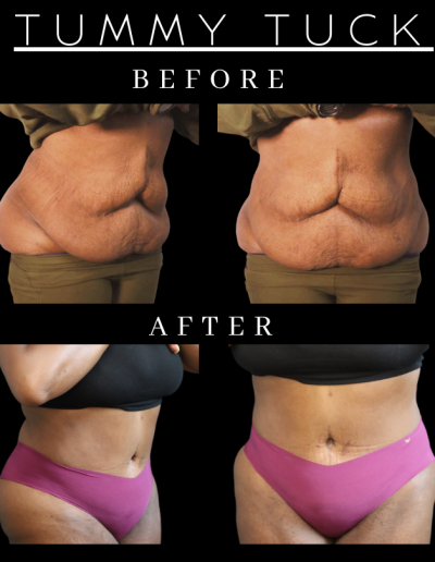 Abdominoplasty