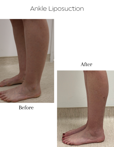 Liposuction