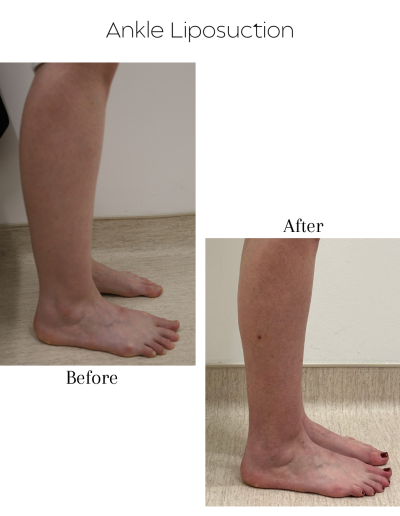 Liposuction