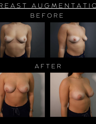 Breast Augmentation