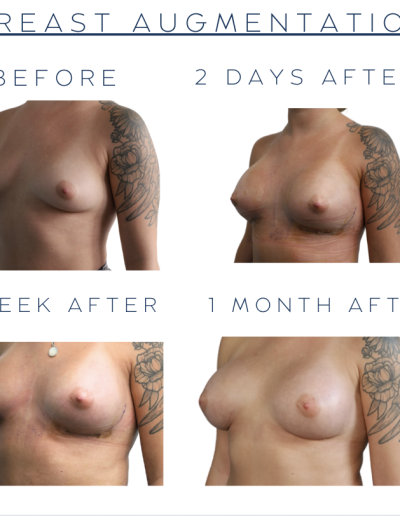 Breast Augmentation
