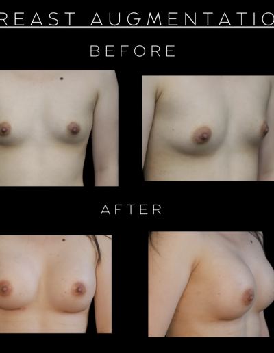 Breast Augmentation