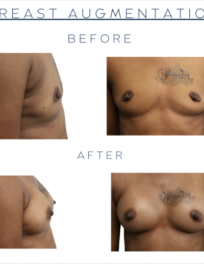 Breast Augmentation