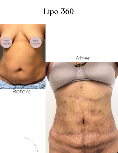 Liposuction