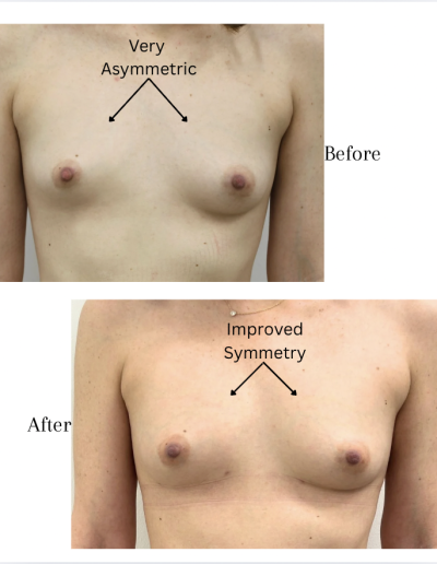 Fat Transfer to the Breast
