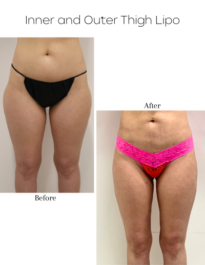 Liposuction