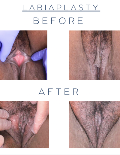 Labiaplasty