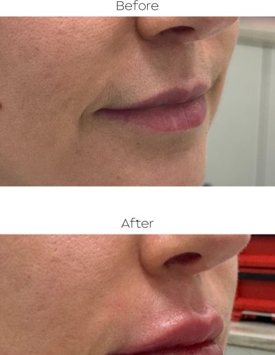 Lip Filler