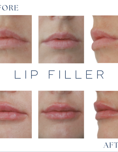 Lip Filler