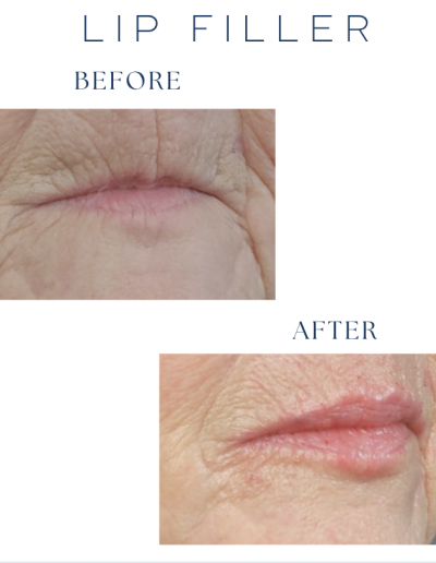 Lip Filler