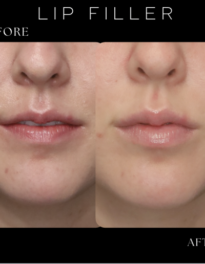 Lip Filler