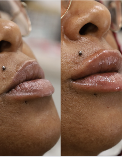 Lip Filler