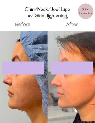 Liposuction