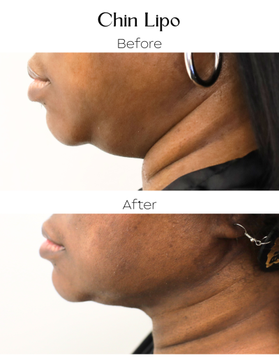 Liposuction