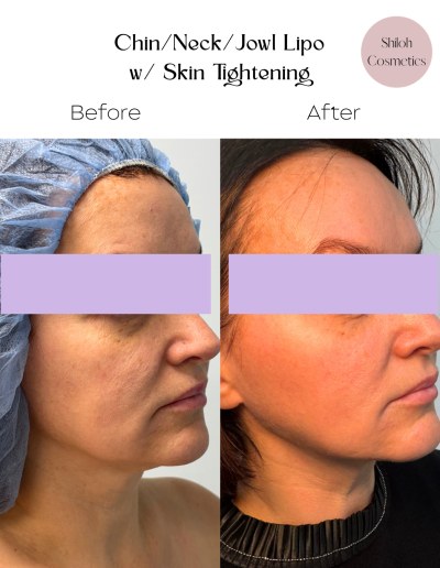 Liposuction