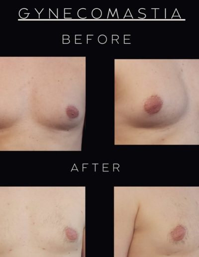 Liposuction