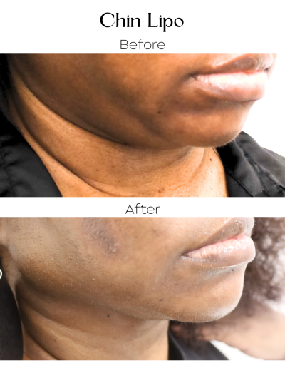 Liposuction
