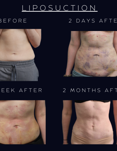 Liposuction
