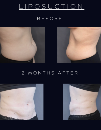 Liposuction