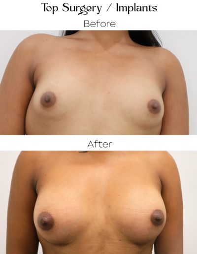 Male to Female Surgery