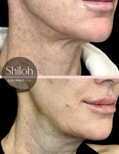 Neck Lift